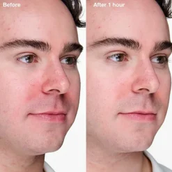 Hombre CLINIQUE Anti-Blemish Solutions Clinical