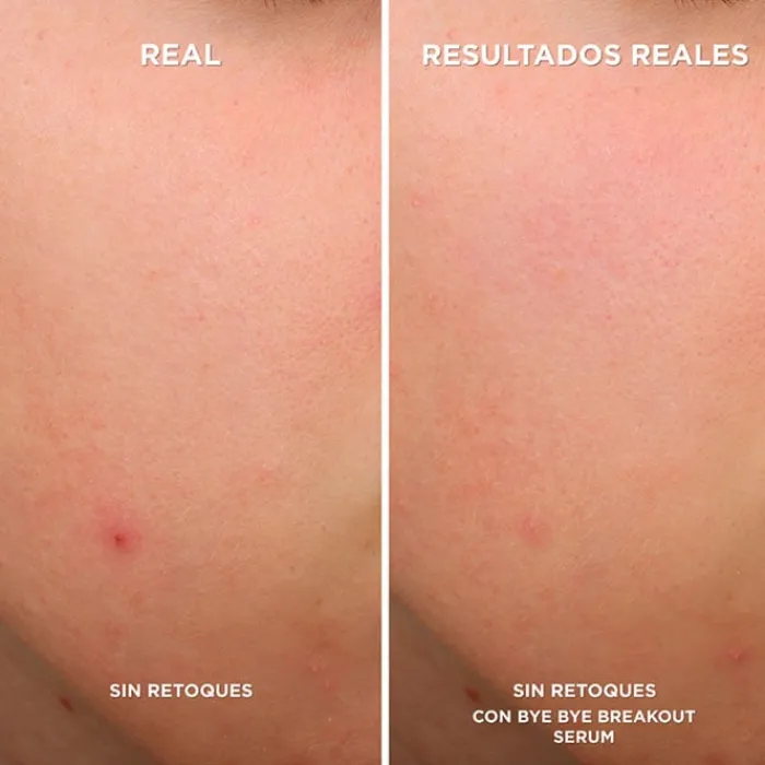IT COSMETICS Bye Bye Breakout Sérum
